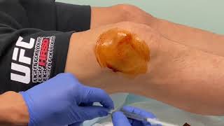 MoraMD Knee Effusion Aspiration A Nearly Painless Technique [upl. by Carola]