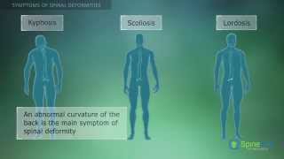 Spinal Deformities Symptoms [upl. by Canale832]