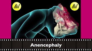 Anencephaly Explained [upl. by Rothstein696]