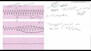 Comparing ventricular rhythms [upl. by Oirramed422]