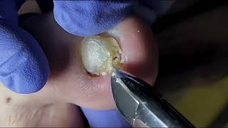 Ingrown Toenail Removal  Pedicure Treatment and Very Satisfying  Best Satisfying Nail Cutting [upl. by Nored]