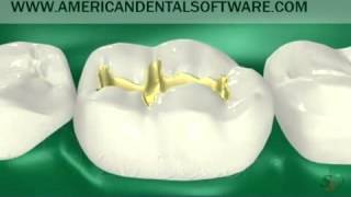 Clearwater FL Dentists Share Video Animation of Dental Resin Filling [upl. by Eachern]