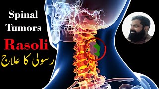 Spinal Cord Tumor Treatment in Urdu Hindi  ट्यूमर का इलाज  رسولی کا علاج [upl. by Shore]