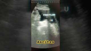 Ascites ultrasound abdomen ascites medical study shortfeed shortsviral hepatitisc ytviral [upl. by Berthoud]