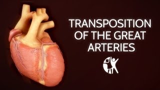 Transposition of the Great Arteries [upl. by Yssirc]