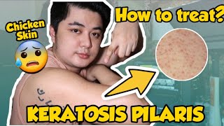 HOW TO TREAT KERATOSIS PILARIS  Chicken Skin  By Mark de Leon [upl. by Lilyan633]