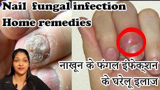 Paronychia treatment home remedies in hindi How to cure Nail fungus  Onychomycosis [upl. by Ennoved700]