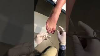 Checking Toe is Completely Numb Before Ingrown Nail Surgery Procedure [upl. by Aniala]