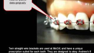 How important is the position of your orthodontic braces [upl. by Sivel]