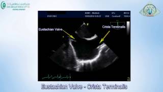 Normal Right Atrial Variants [upl. by Angelique400]