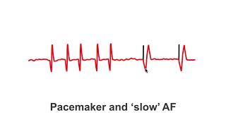 Pacemakers and slow AF patients [upl. by Redford]