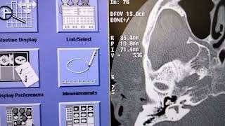 how to make recon on GE CT of hrct temporal bone Rtamp Lt [upl. by Ellevart4]