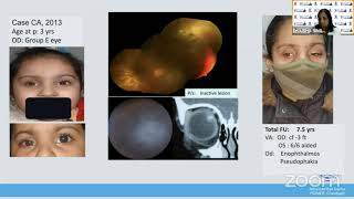 AIOC2021FP1944DrUSHA SINGHComplications and side effects of Intra arterial Chemotherapy for Ret [upl. by Jacobah]