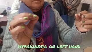 hypokinesia testing in Parkinsons Diseasedoctor sathi [upl. by Herrera]