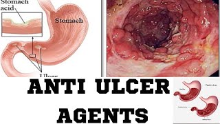 Anti Ulcer AgentsPPIH2 RECEPTOR ANTAGONISAMHARIC TUTORIAL [upl. by Eniwtna]