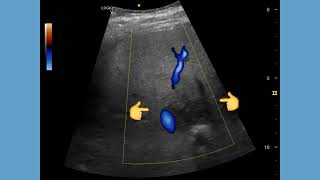 Focal fatty sparing of liver ultrasound and color Doppler video Hypoechoic or dark patch liver [upl. by Htiaf]