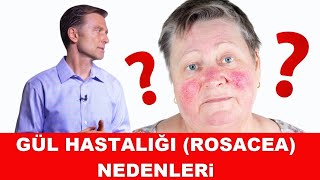 Gül Hastalığı Rosacea Nedenleri ve Tedavisi [upl. by Enairb39]