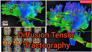 Diffusion Mri Fiber Tensor imaging tractography of the Brain  Siemens tractography in Hindi Mri [upl. by End]