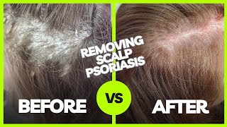 Removing Plaque Scalp Psoriasis  Using The AntiFungal Bundle myhappyscalpcom [upl. by Ailehpo]