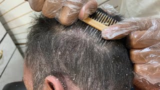 How to get rid old dandruff flakes permanently 🥵how to get rid of dandruff naturally 💯 [upl. by Inama838]