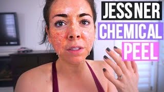 NIKKI GETS A NEW FACE Jessner Chemical Peel Review Before and After [upl. by Fantasia322]