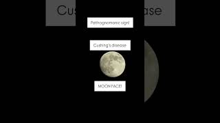 Cushings disease pathology endocrinesystem cushing exam usmle [upl. by Nolahs242]