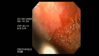 Esophagogastroduodenoscopy [upl. by Nylhsa]