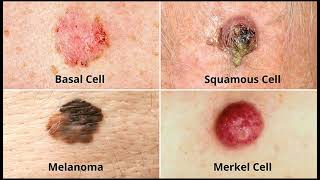 Skin Cancer  Medical Common Sense [upl. by Otto]