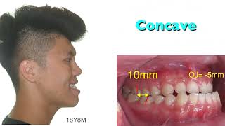 Nonsurgical Correction of A Severe Class III Malocclusion with Miniscrews｜【Chris Chang Ortho】CC424 [upl. by Roti709]