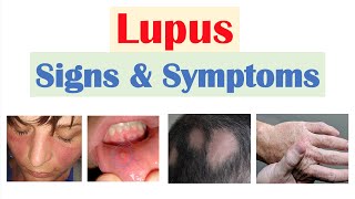 Lupus Signs amp Symptoms amp Why They Occur  Skin Joints Organ Systems [upl. by Janyte432]