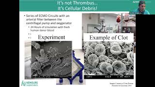 Hemolysis in Pediatric ECLS [upl. by Ainoval]