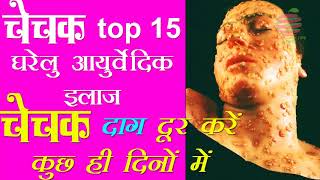 चेचक का इलाज है ये नुस्खे Home remedies for smallpox chechak ke daag ka ilaj in hindi  2017  11 [upl. by Derk]