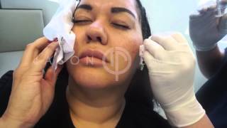 Radiesse Soft Tissue Filler Cheek Augmentation  Filler to Cheeks  Non Invasive Facial Contouring [upl. by Michal]