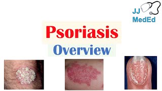 Overview of Psoriasis  What Causes It What Makes It Worse  Subtypes and Treatment [upl. by Salohcin87]