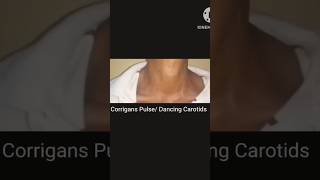 Corrigans Pulse  Dancing Carotids  Collapsing Pulse  water Hammer Pulse [upl. by Siraved]