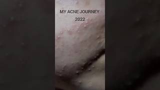 My acne journeyshorts trending acne acnetreatment short shortvideo viralvideo viralshorts [upl. by Yelmene]