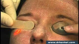 Live Laser Skin Resurfacing Active FX® on a Patients Face [upl. by Jona]