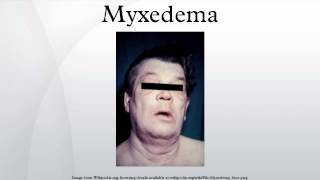 Myxedema [upl. by Bick]