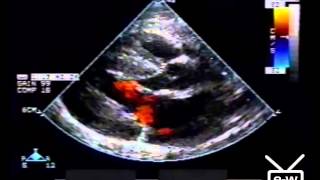 The EchoWeb Youtube Archives  3 Cardiac Conditions [upl. by Melly250]