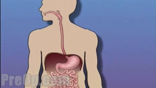 Esophagogastroduodenoscopy [upl. by Accever695]