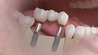 Straumann  Trattamento di più denti su impianto [upl. by Graner]