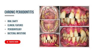 Chronic periodontitis Etiology Clinical features periodontal health [upl. by Martinelli]