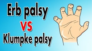 Erbs Palsy vs Klumpkes Palsy [upl. by Eidoc876]