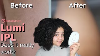 Lumi LASER HAIR REMOVAL Review amp 1 Month ResultsRoseSkinCo [upl. by Amedeo]