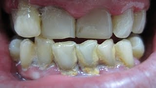 Home remedies for periodontitis pyorrhea  periodontal disease treatment [upl. by Tito]