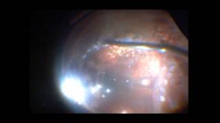 Vitrectomy for Retinal Detachment  PVR  Retinectomy  Dr Manish Nagpal [upl. by Vasili]