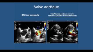 Echographie cardiaque transthoracique lessentiel a comprendre pour liECN [upl. by Catriona]