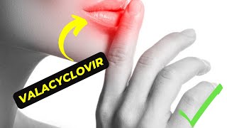 Valacyclovir The Antiviral Medication That Can Help Treat Herpes and Cold Sores [upl. by Neladgam56]