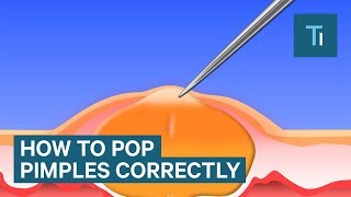 The Only Right Way To Pop Your Pimples [upl. by Akerue291]