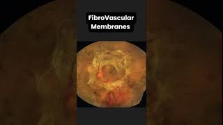 Tractional Retinal Detachment ophthalmologyretina [upl. by Tavi]